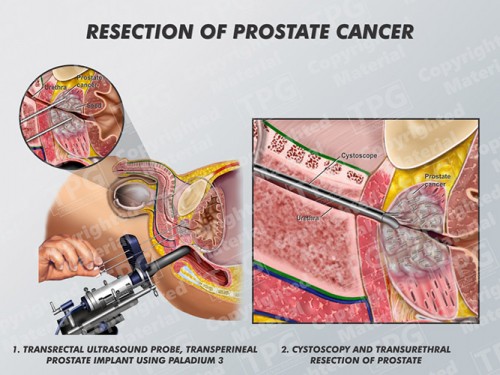 resection-of-prostate-cancer