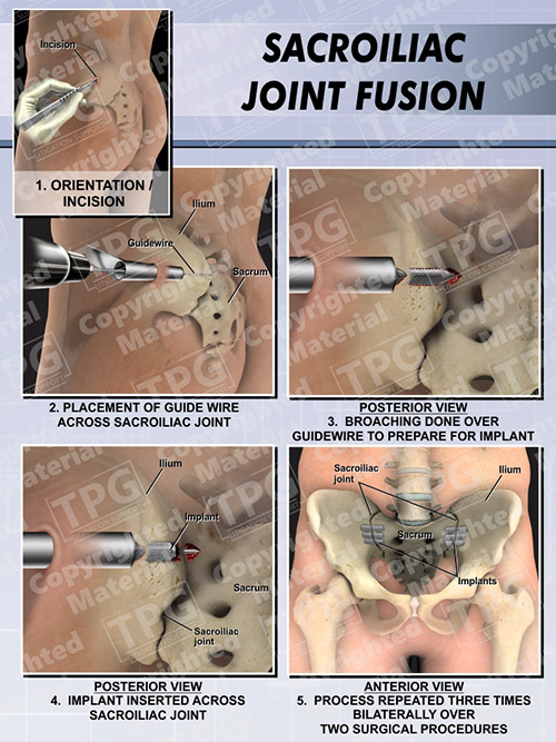sacroiliac-joint-fusion