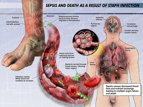 sepsis-and-death-as-a-result-of-staph-infection