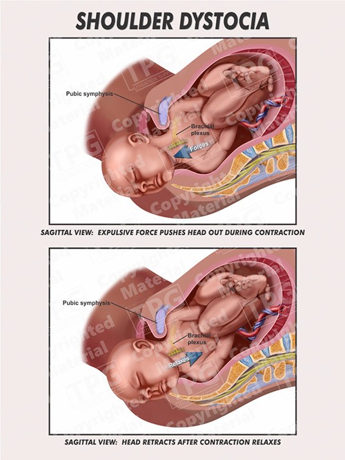 shoulder-dystocia-fetus