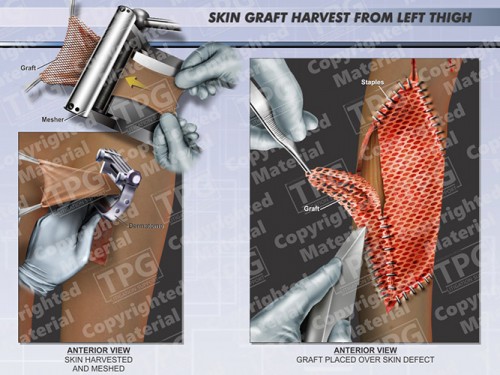 skin-graft-harvest-from-left-thigh
