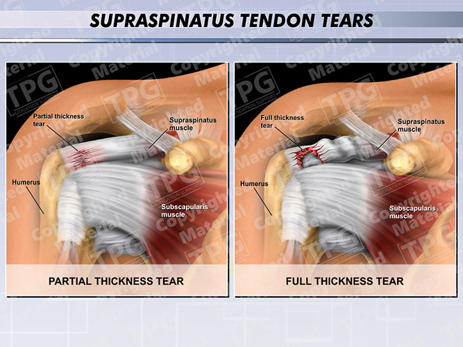 Full thickness tear of deals the supraspinatus