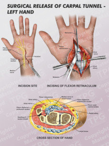 Surgical Release Of Carpal Tunnel Left - Order