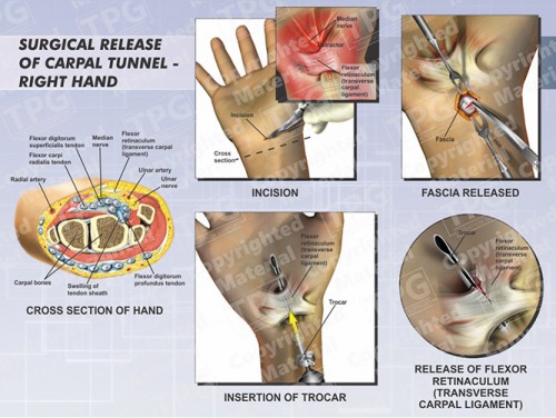 surgical-release-of-carpal-tunnel-right-hand-landscape