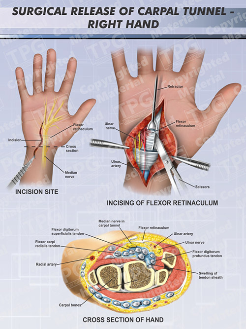surgical-release-of-carpal-tunnel-right-hand-portrait