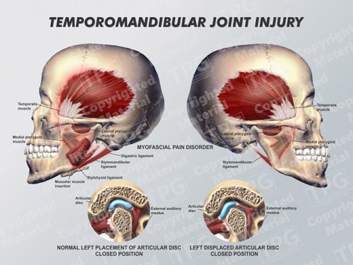 temporomandibular-joint-injury