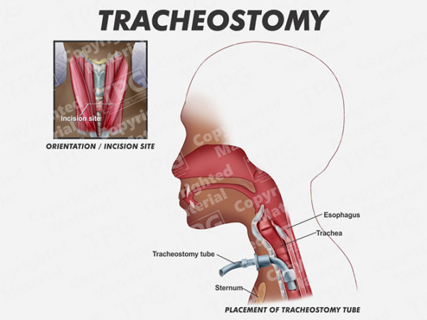 Tracheostomy Lateral Child