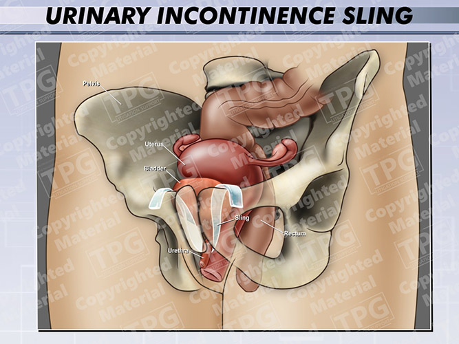 urinary-incontinence-sling