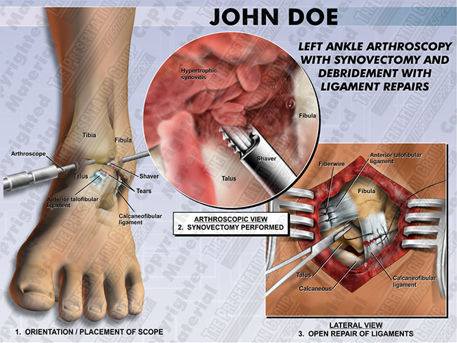 ankle-arthroscopy-synovectomy-debridement-ligament-repair