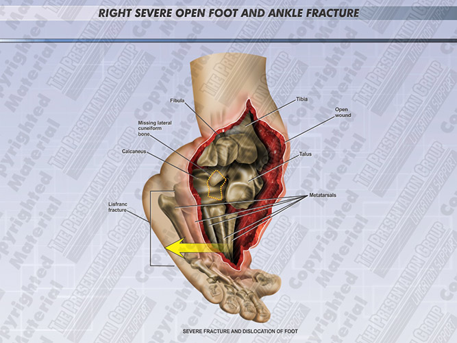 ankle-and-foot-fracture-severe