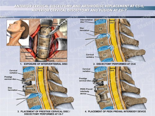 anterior-cervical-discectomy-fusion-arthrodisc-replacement-c5-6-c6-7