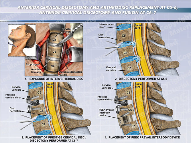 anterior-cervical-discectomy-fusion-arthrodisc-replacement-c5-6-c6-7