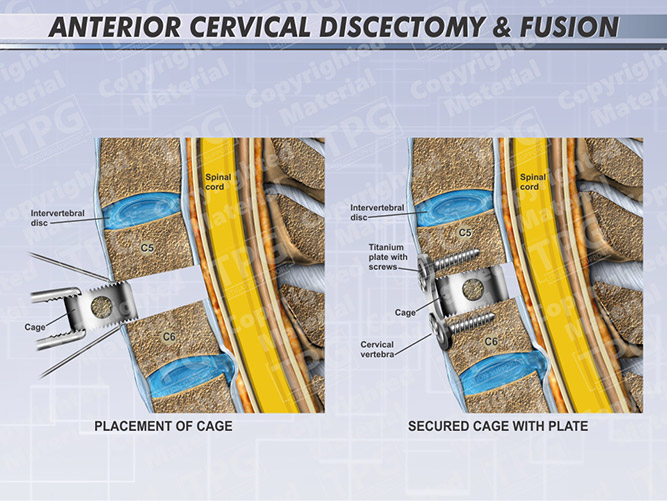 anterior-cervical-discectomy-fusion-one-level