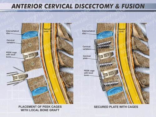 anterior-cervical-discectomy-fusion-two-level