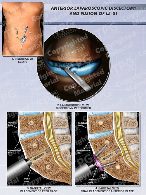 anterior-laparoscopic-microdiscectomy-fusion-l5-s1