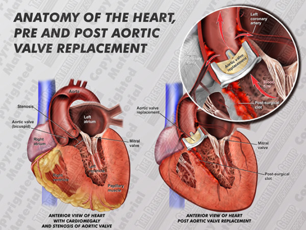 Aortic Valve Replacement | Medical Legal Illustration