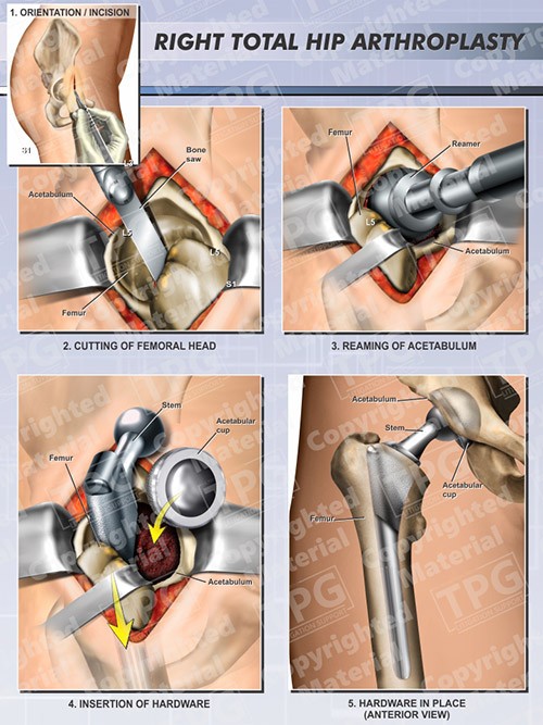 arthroplasty-right-hip-total