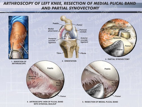 arthroscopy-left-knee-resection-medial-plical-band-partial-synovectomy