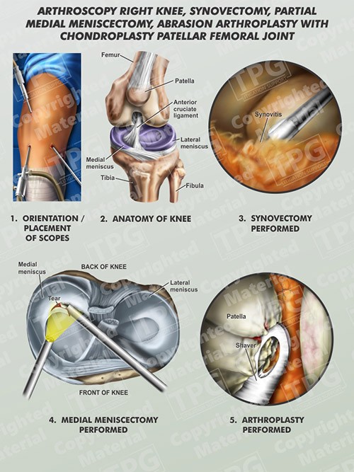 arthroscopy-right-knee-synovectomy-medial-meniscectomy