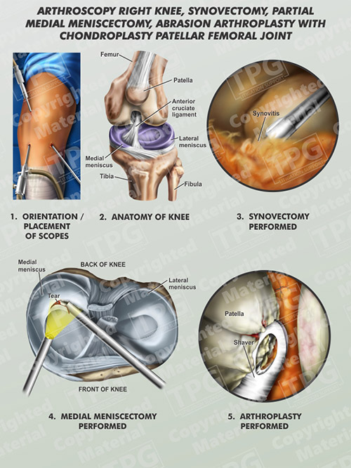 Arthroscopy RT Knee Synovectomy Med Meniscectomy Order