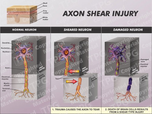 axon-shear-injury-before-after