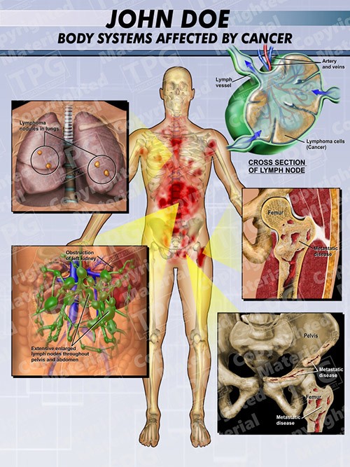 cancer-body-systems-affected
