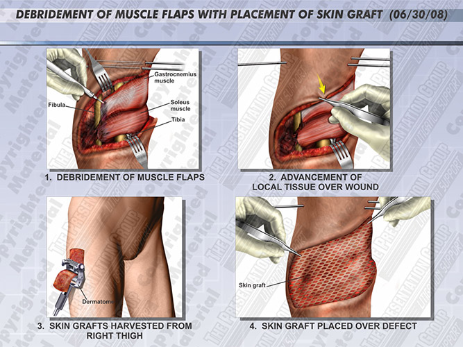 debridement-muscle-flaps-skin-graft-placement