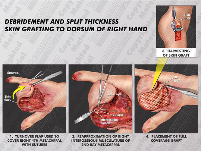 debridement-and-graft-right-hand
