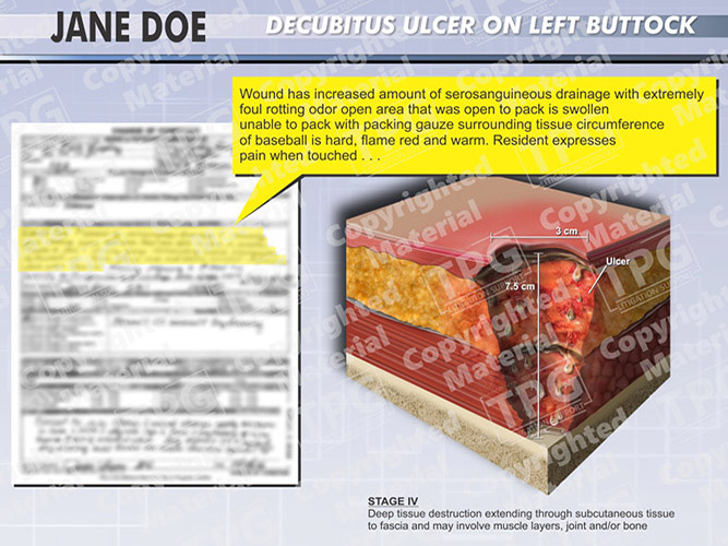 decubitus ulcer buttock icd 10