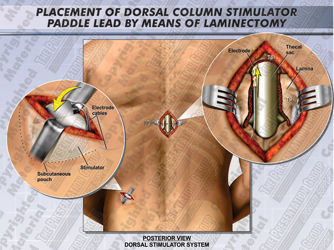 dorsal-stimulator-paddle-lead-placement-with-laminectomy