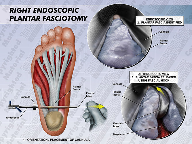 endoscopic-plantar-fasciotomy-right