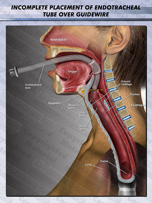endotracheal-tube-guidewire-incomplete-placement