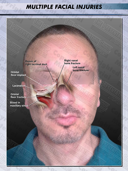 facial-injuries-multiple-male