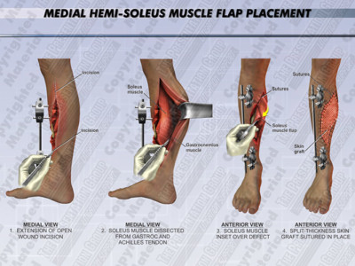 Medical Illustration - Medical Trial Exhibits | Presentation Group