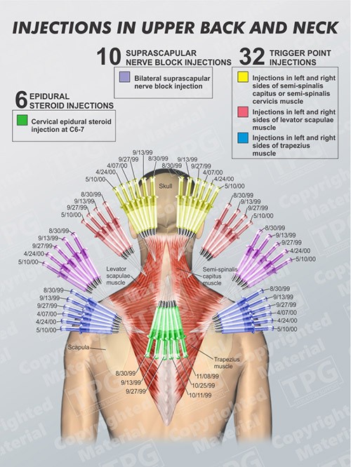 injections-in-upper-back-and-neck