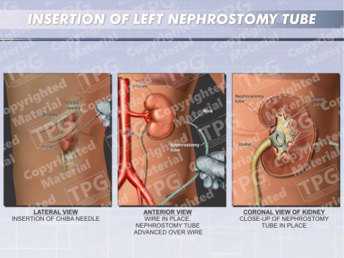Insertion-Left-Nephrostomy-Tube