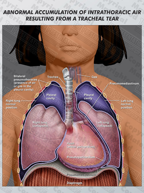intrathoracic-air-resulting-from-tracheal-tear