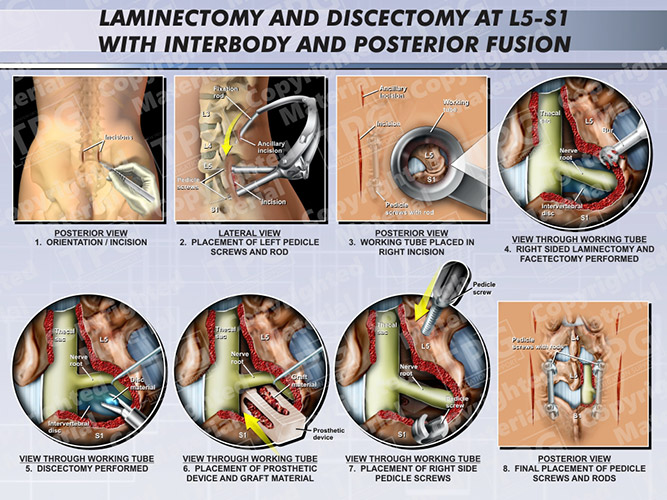 Laminectomy And Discectomy At L5 S1 With Interbody And Posterior Fusion Presentation Group 