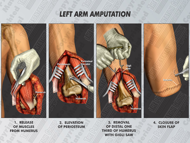 left-arm-amputation