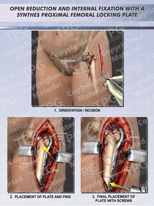 open-reduction-internal-fixation-synthes-proximal-femoral-locking-plate-hip