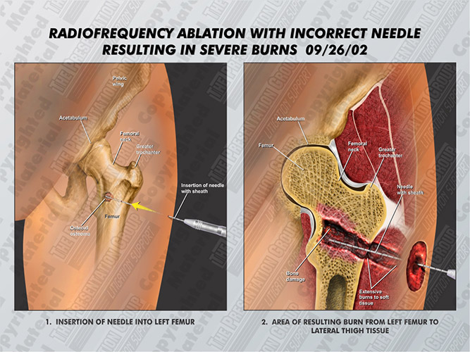 radiofrequency-ablation-incorrect-needle