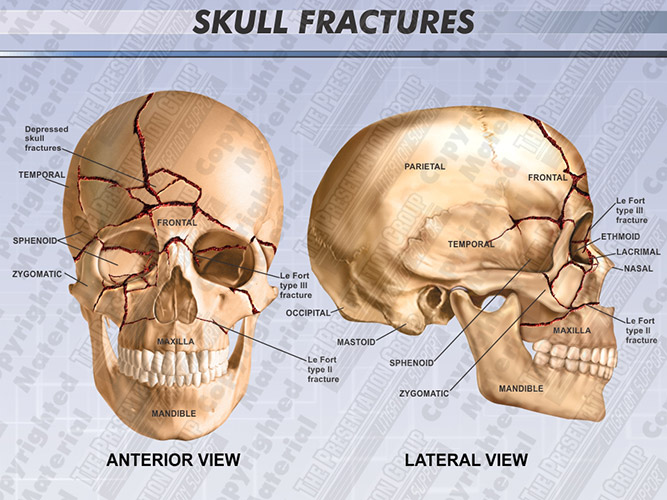 skull fracture long term effects