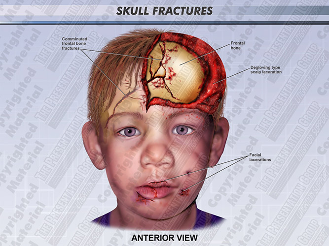 Medical Legal Illustration Skull Fracture Anterior View