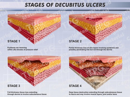 stages-decubitus-ulcers