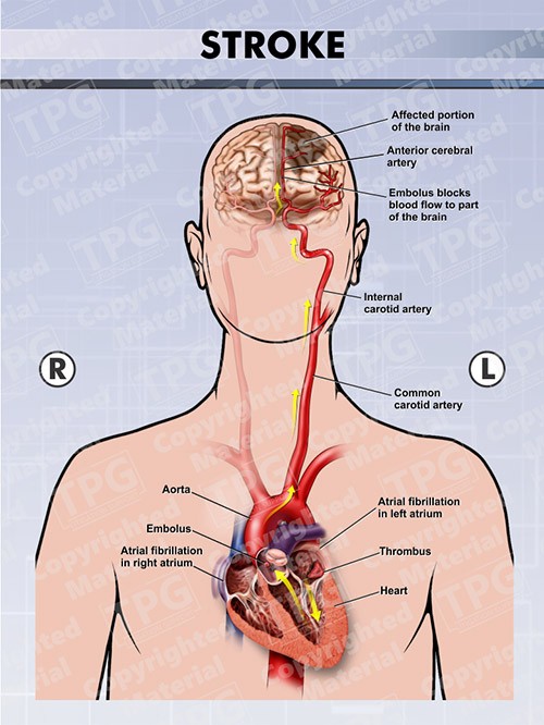 stroke-anterior-view