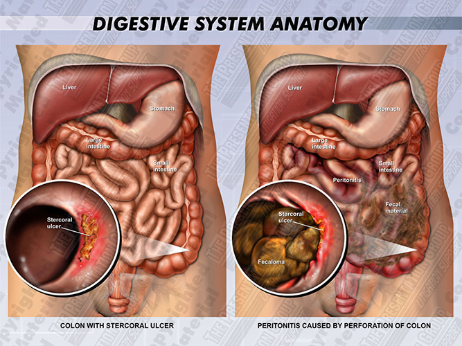 ulcer-bowel-digestive-system-anatomy