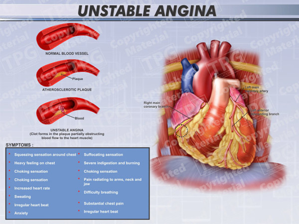 Unstable Angina - Order