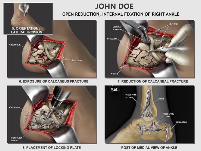 Open Reduction Internal Fixation Right Ankle