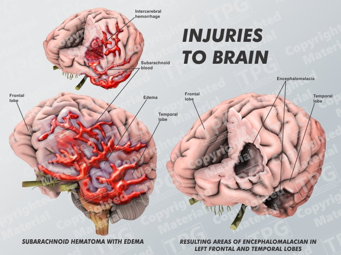 Brain Injury Medical Legal Illustration
