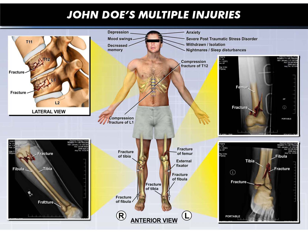 Multiple Injury Board/Colorized Film - Presentation Group